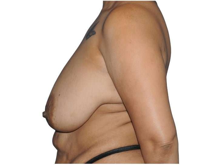Tummy Tuck Before & After Patient #493