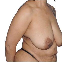 Mommy Makeover Before & After Patient #433
