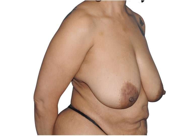 Mommy Makeover Before & After Patient #433