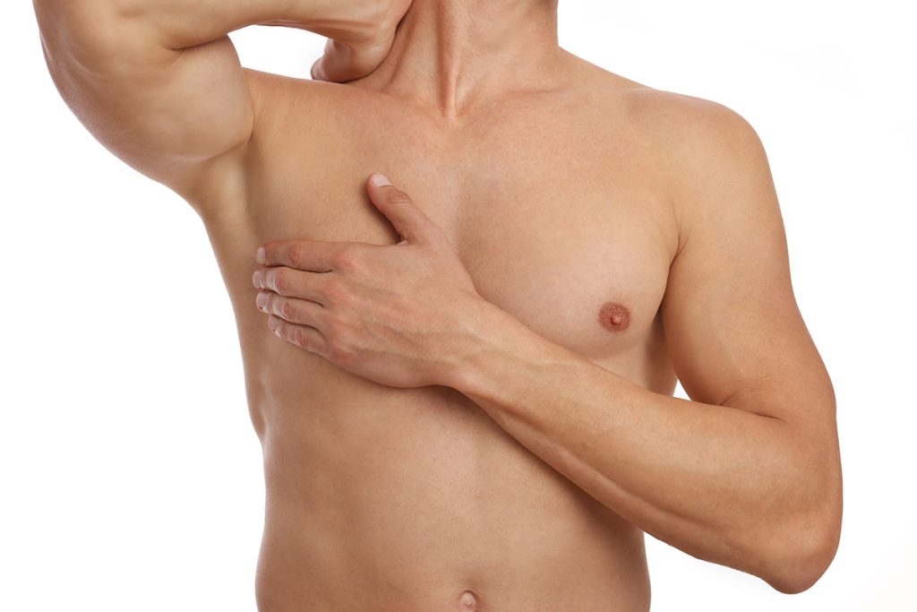 Gynecomastia